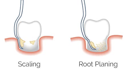 Scaling and Root Planing